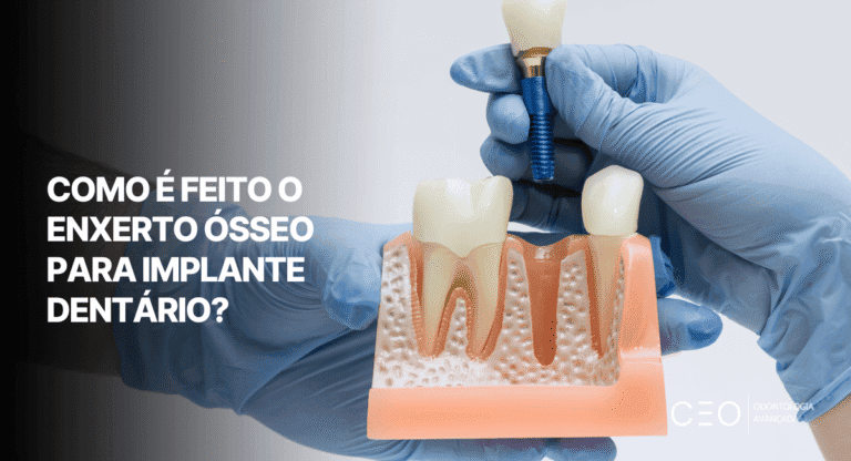 Imagem de abertura mostra modelo de arcada dentária com implante e pergunta como é feito o enxerto ósseo para implante dentário.