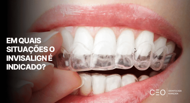 Invisalign - CEO | Odontologia Premium