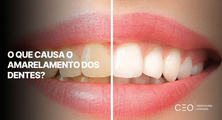 O que causa o amarelamento dos dentes - CEO Clínica - Odontologia Avançada