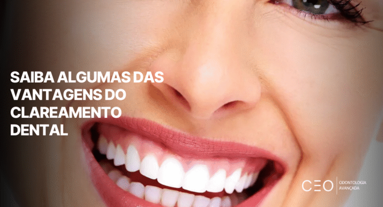 Saiba algumas das vantagens do clareamento dental - CEO Clínica - Odontologia Avançada