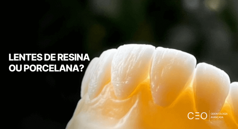 Prótese dentária ilustrativa destacando a diferença entre Lentes de resina ou porcelana para harmonização estética do sorriso.