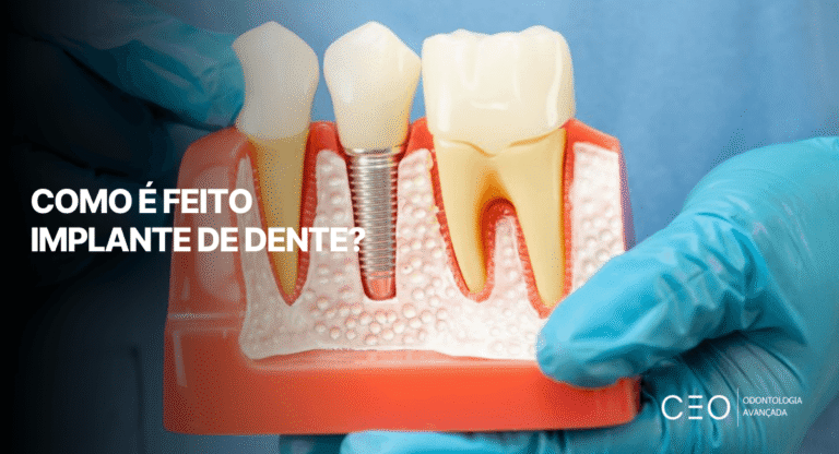 Modelo odontológico mostrando implante fixado no osso e coroa dentária, ilustração explicativa de como é feito implante de dente e da estrutura utilizada no procedimento odontológico.