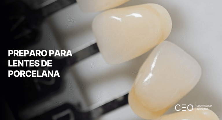 Close em lentes dentárias com texto explicativo sobre preparo para lente de porcelana passo a passo.