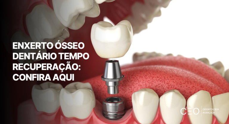 Ilustração de implante dentário com coroa e componentes protéticos, relacionada ao enxerto ósseo dentário tempo recuperação.