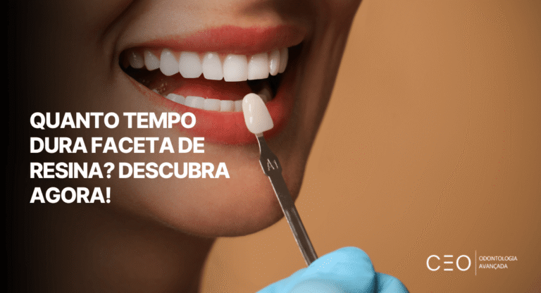 Capa do artigo sobre quanto tempo dura faceta de resina com sorriso e demonstração de faceta odontológica em primeiro plano.