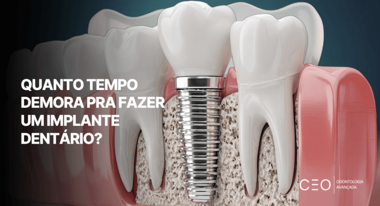 Imagem de abertura mostra um implante dentário em detalhe e pergunta quanto tempo demora para realizar o procedimento.