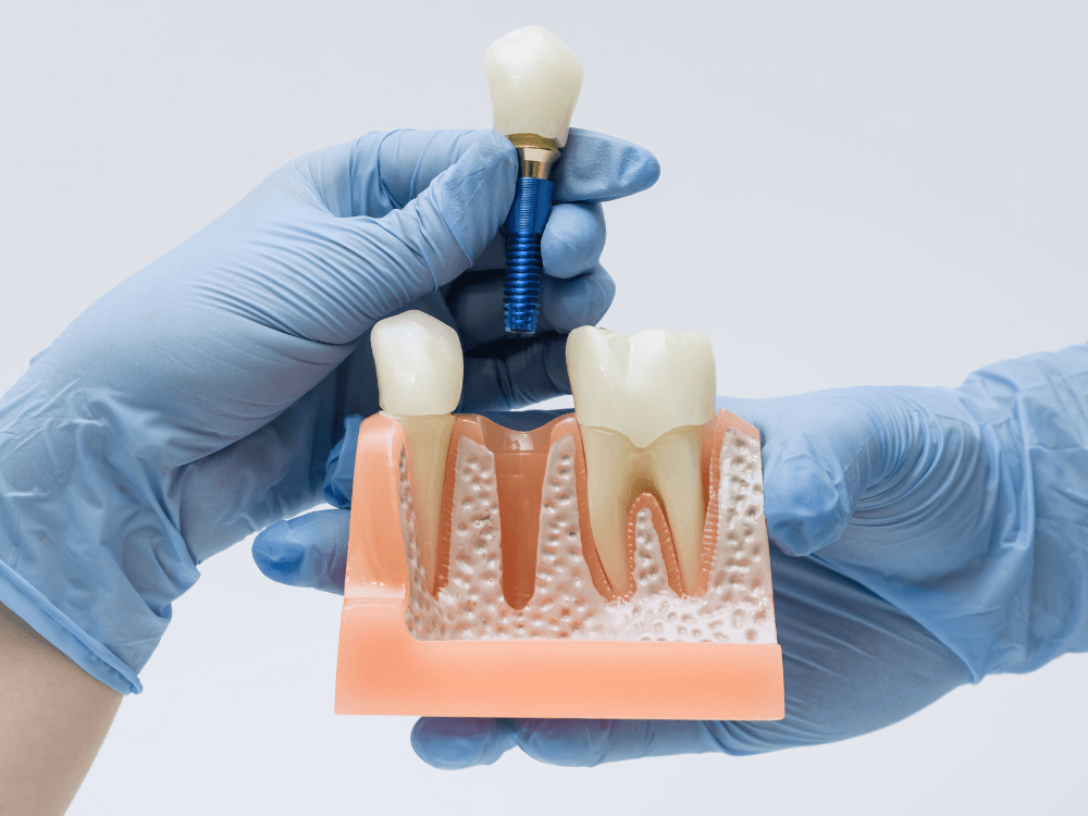 Mãos com luvas seguram um modelo da arcada e um implante dentário, ilustrando a relação entre o implante e o tecido ósseo.