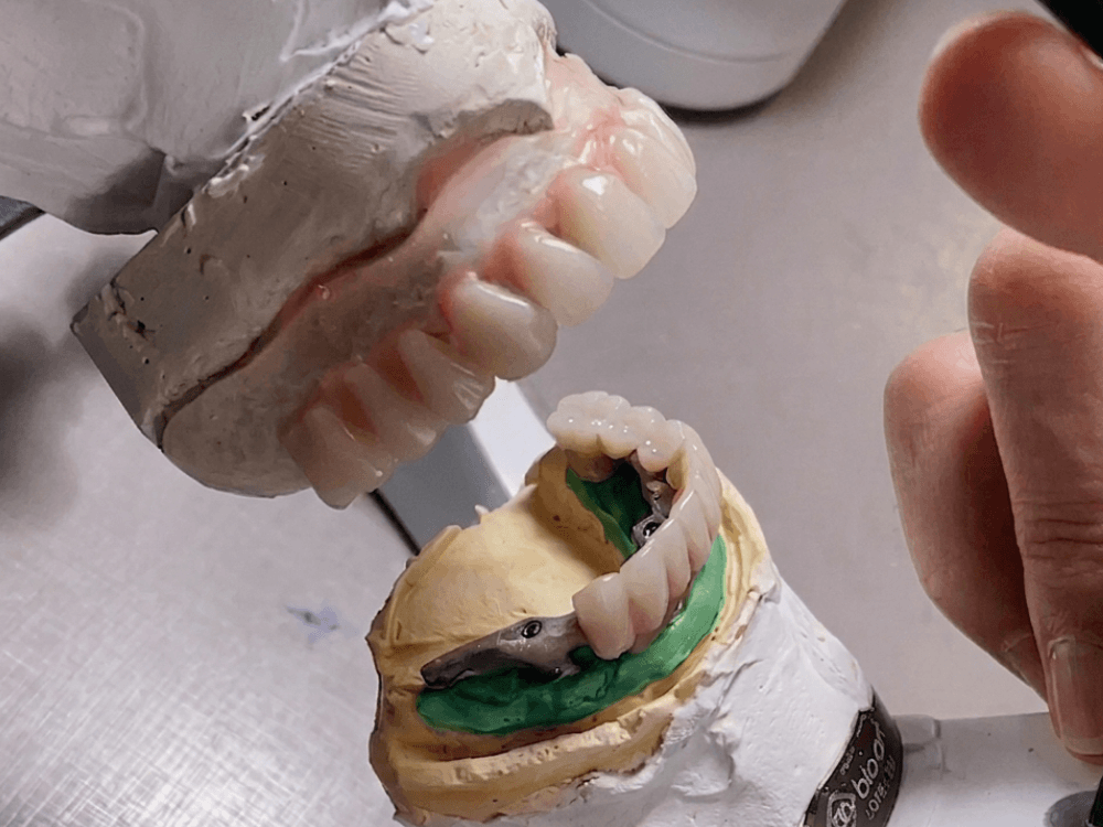 Modelo odontológico com prótese dentária e estrutura de suporte sendo analisado durante o planejamento de um tratamento com implante.