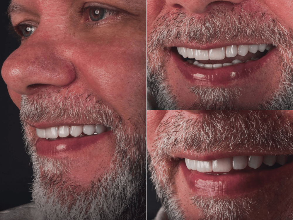 Colagem mostra diferentes ângulos de um homem sorrindo, destacando dentes reabilitados e o resultado estético do tratamento odontológico.