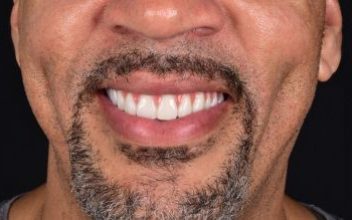 Durabilidade elevada - Implante Dentário em Balneário Camboriú - CEO Clínica