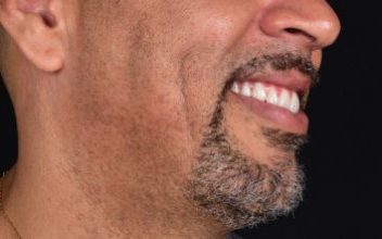 Melhor eficiência mastigatória - Implante Dentário em Balneário Camboriú - CEO Clínica