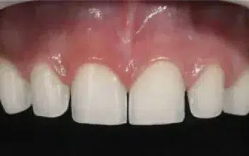 Procedimento Minimamente Invasivo - Facetas Dentais em Balneário Camboriú